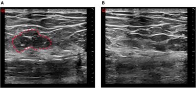 Incision pressing, a simple and effective intervention to reduce colorectal surgical site infection: A propensity score-matched study